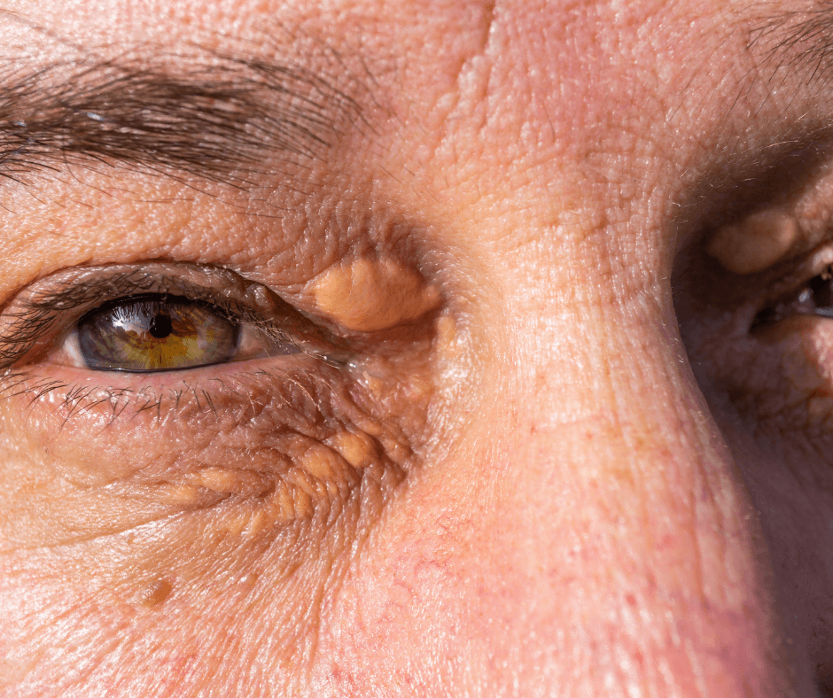 xanthelasma weghalen